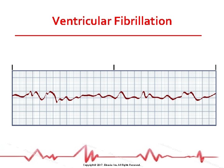 Ventricular Fibrillation Copyright © 2017, Elsevier Inc. All Rights Reserved. 