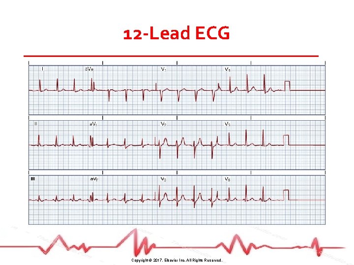 12 -Lead ECG Copyright © 2017, Elsevier Inc. All Rights Reserved. 