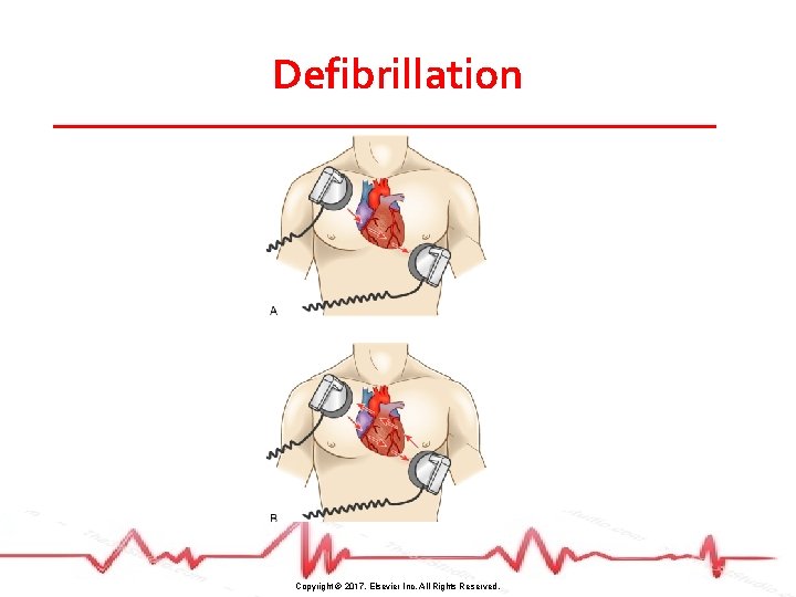 Defibrillation Copyright © 2017, Elsevier Inc. All Rights Reserved. 