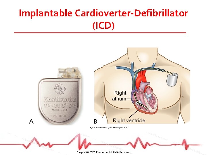Implantable Cardioverter-Defibrillator (ICD) Copyright © 2017, Elsevier Inc. All Rights Reserved. 