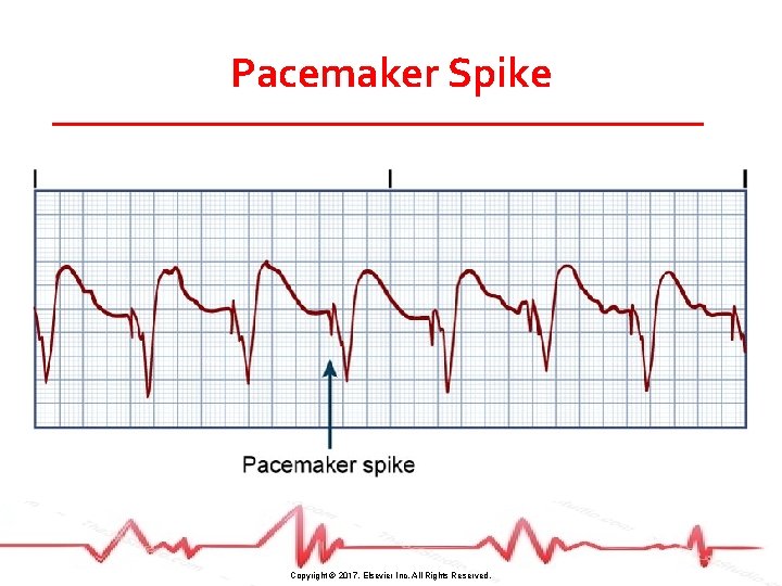 Pacemaker Spike Copyright © 2017, Elsevier Inc. All Rights Reserved. 