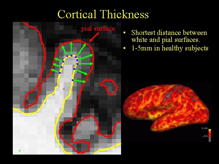 Cortical Thickness pial surface • Shortest distance between white and pial surfaces. • 1