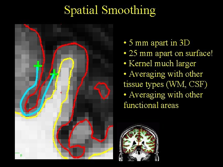 Spatial Smoothing • 5 mm apart in 3 D • 25 mm apart on