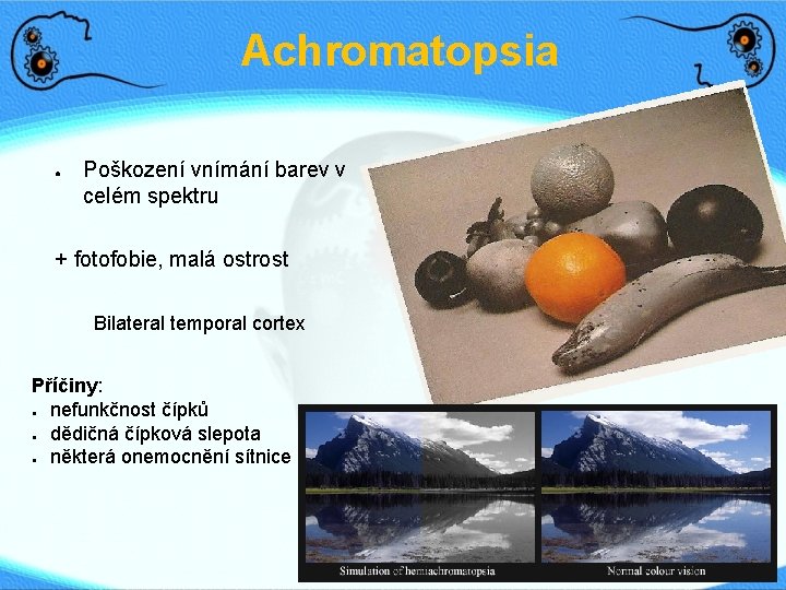 Achromatopsia ● Poškození vnímání barev v celém spektru + fotofobie, malá ostrost Bilateral temporal