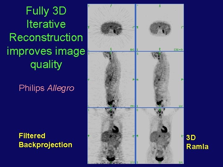 Fully 3 D Iterative Reconstruction improves image quality Philips Allegro Filtered Backprojection 3 D
