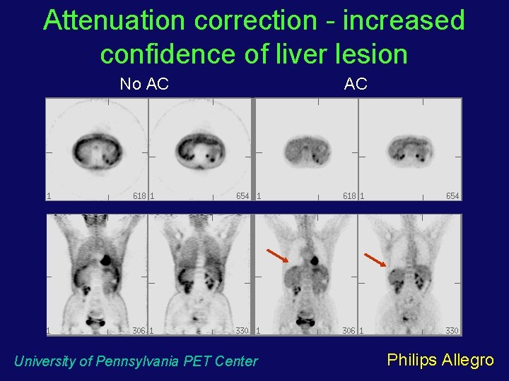 Attenuation correction - increased confidence of liver lesion No AC University of Pennsylvania PET