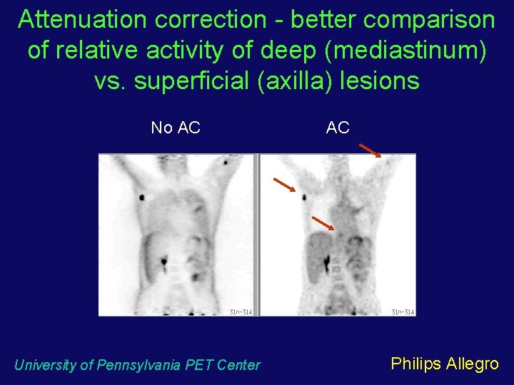 Attenuation correction - better comparison of relative activity of deep (mediastinum) vs. superficial (axilla)
