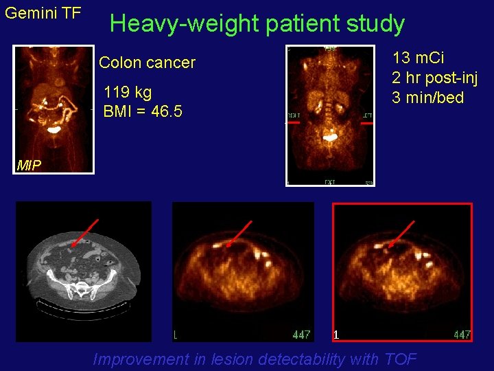 Gemini TF Heavy-weight patient study 13 m. Ci 2 hr post-inj 3 min/bed Colon