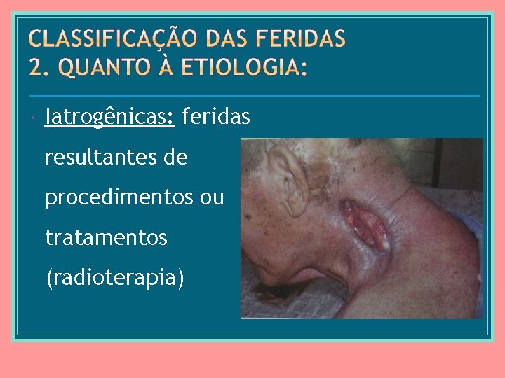  Iatrogênicas: feridas resultantes de procedimentos ou tratamentos (radioterapia) 