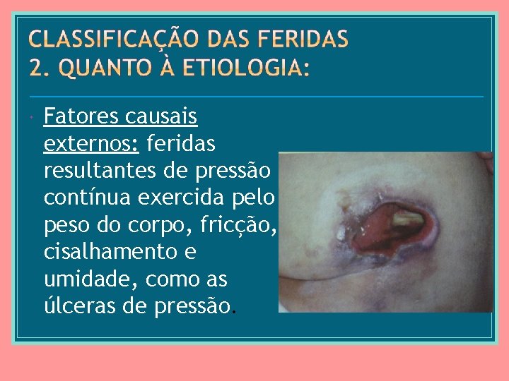  Fatores causais externos: feridas resultantes de pressão contínua exercida pelo peso do corpo,