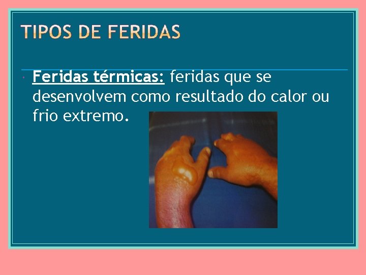  Feridas térmicas: feridas que se desenvolvem como resultado do calor ou frio extremo.