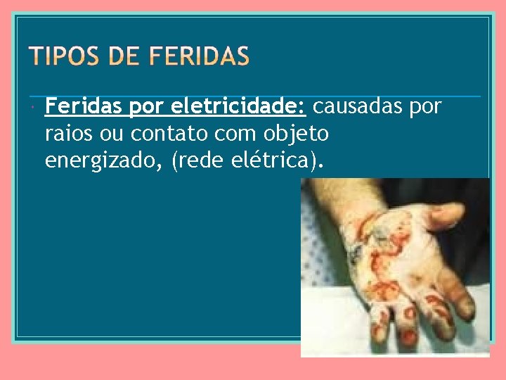  Feridas por eletricidade: causadas por raios ou contato com objeto energizado, (rede elétrica).