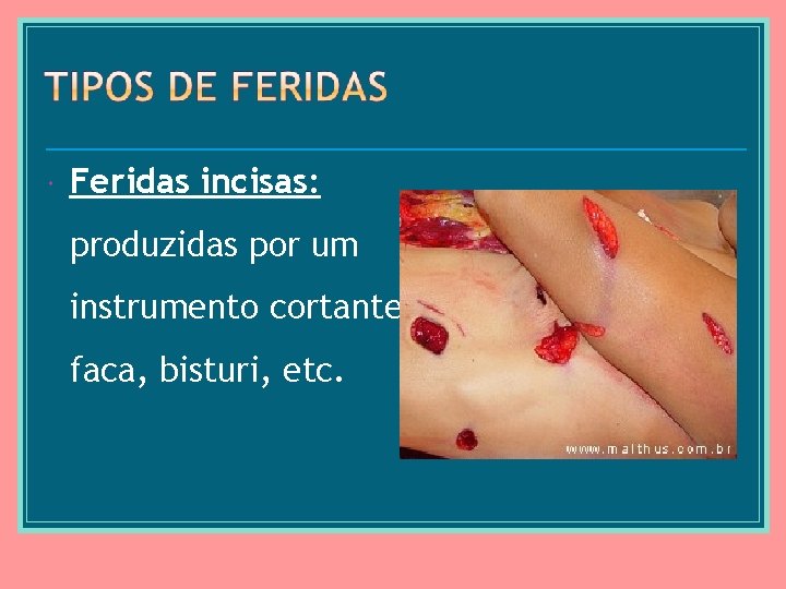  Feridas incisas: produzidas por um instrumento cortante, faca, bisturi, etc. 