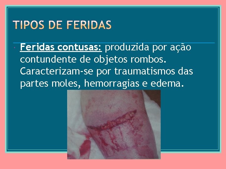  Feridas contusas: produzida por ação contundente de objetos rombos. Caracterizam-se por traumatismos das