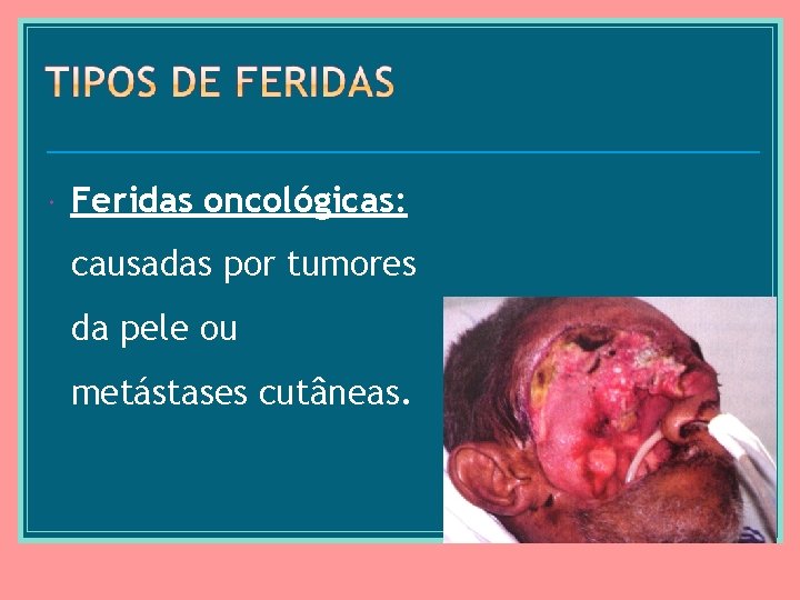  Feridas oncológicas: causadas por tumores da pele ou metástases cutâneas. 