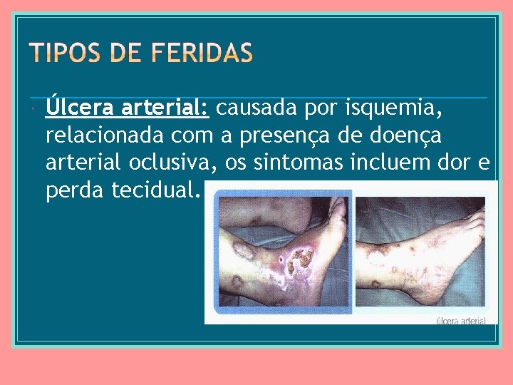  Úlcera arterial: causada por isquemia, relacionada com a presença de doença arterial oclusiva,