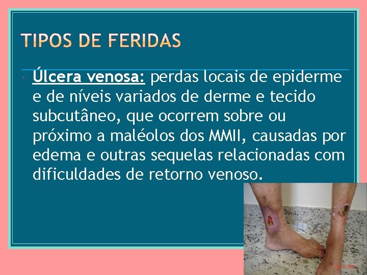  Úlcera venosa: perdas locais de epiderme e de níveis variados de derme e