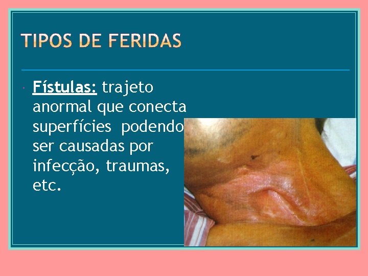  Fístulas: trajeto anormal que conecta superfícies podendo ser causadas por infecção, traumas, etc.