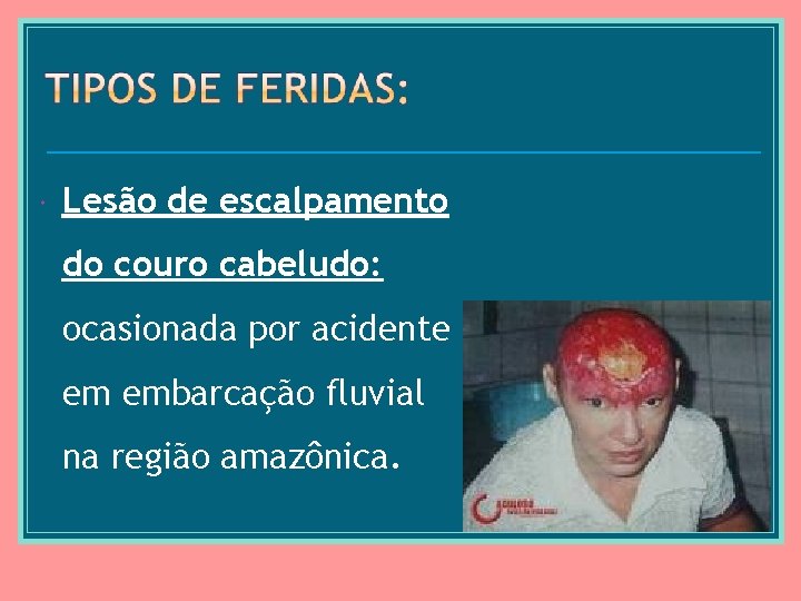  Lesão de escalpamento do couro cabeludo: ocasionada por acidente em embarcação fluvial na