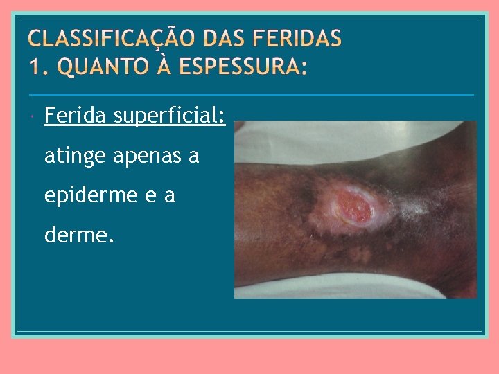  Ferida superficial: atinge apenas a epiderme e a derme. 