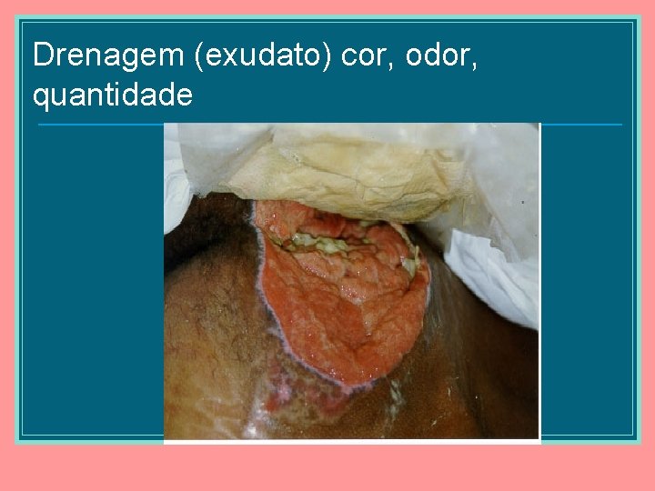 Drenagem (exudato) cor, odor, quantidade 