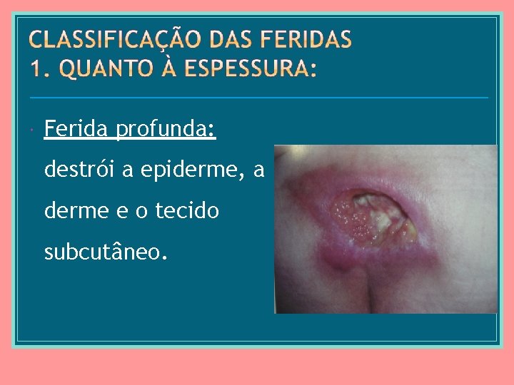  Ferida profunda: destrói a epiderme, a derme e o tecido subcutâneo. 