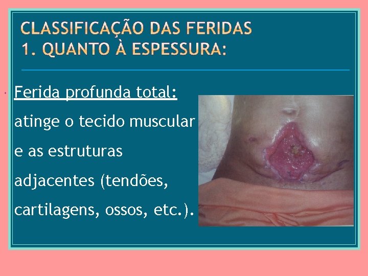  Ferida profunda total: atinge o tecido muscular e as estruturas adjacentes (tendões, cartilagens,