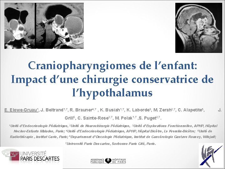 Craniopharyngiomes de l’enfant: Impact d’une chirurgie conservatrice de l’hypothalamus E. Elowe-Gruau 1, J. Beltrand