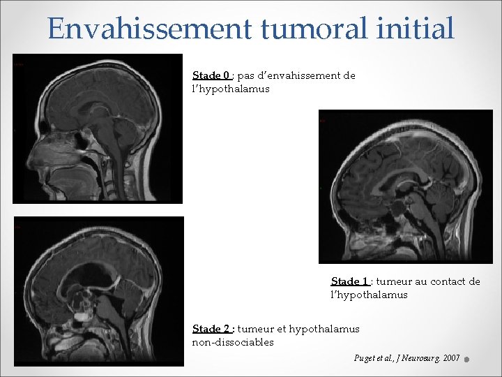 Envahissement tumoral initial Stade 0 : pas d’envahissement de l’hypothalamus Stade 1 : tumeur