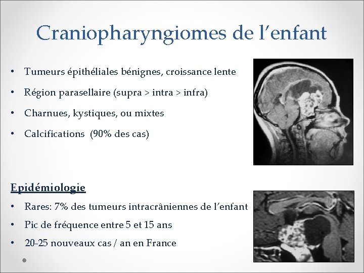Craniopharyngiomes de l’enfant • Tumeurs épithéliales bénignes, croissance lente • Région parasellaire (supra >