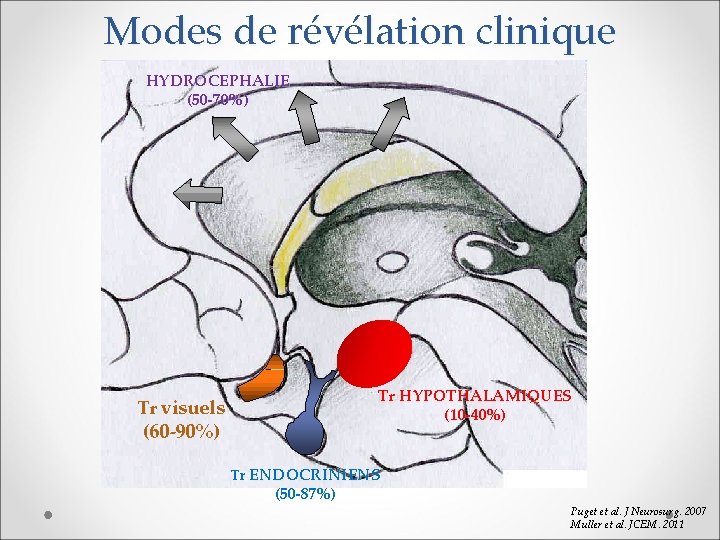 Modes de révélation clinique HYDROCEPHALIE (50 -70%) Tr HYPOTHALAMIQUES (10 -40%) Tr visuels (60