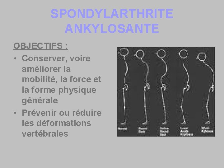 SPONDYLARTHRITE ANKYLOSANTE OBJECTIFS : • Conserver, voire améliorer la mobilité, la force et la