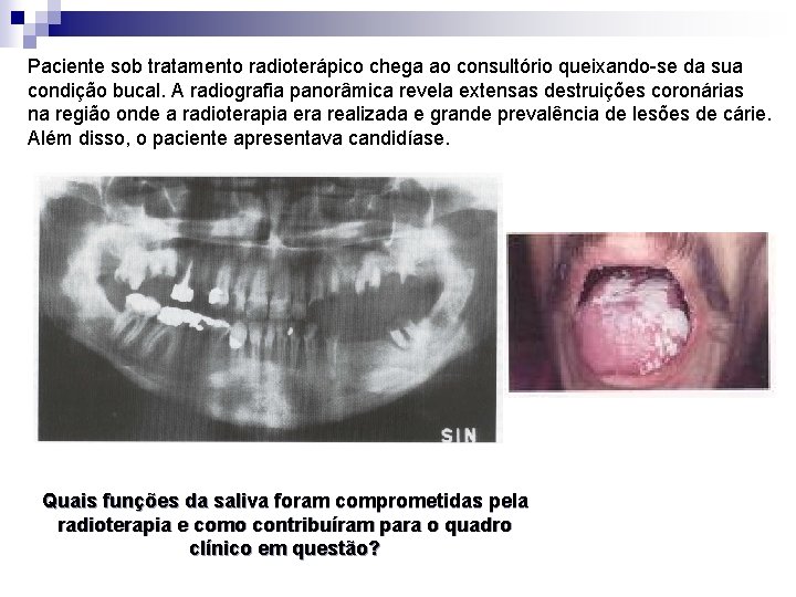 Paciente sob tratamento radioterápico chega ao consultório queixando-se da sua condição bucal. A radiografia