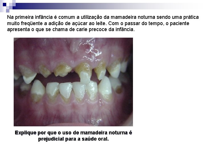 Na primeira infância é comum a utilização da mamadeira noturna sendo uma prática muito