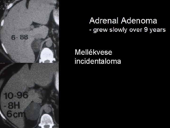kétoldali mellékvese adenoma