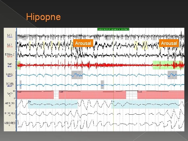 Hipopne Arousal 