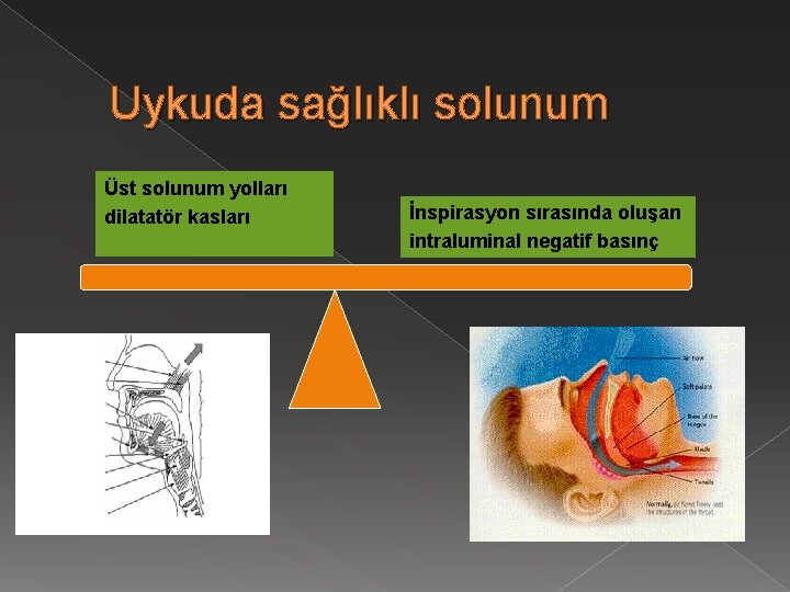 Uykuda sağlıklı solunum Üst solunum yolları dilatatör kasları İnspirasyon sırasında oluşan intraluminal negatif basınç