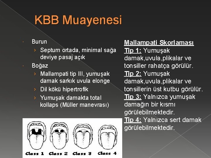 KBB Muayenesi Burun › Septum ortada, minimal sağa deviye pasaj açık Boğaz › Mallampati