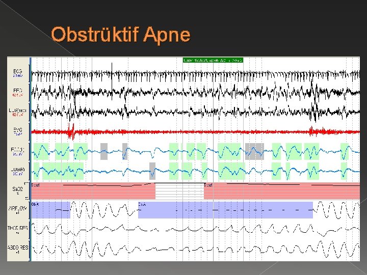 Obstrüktif Apne 