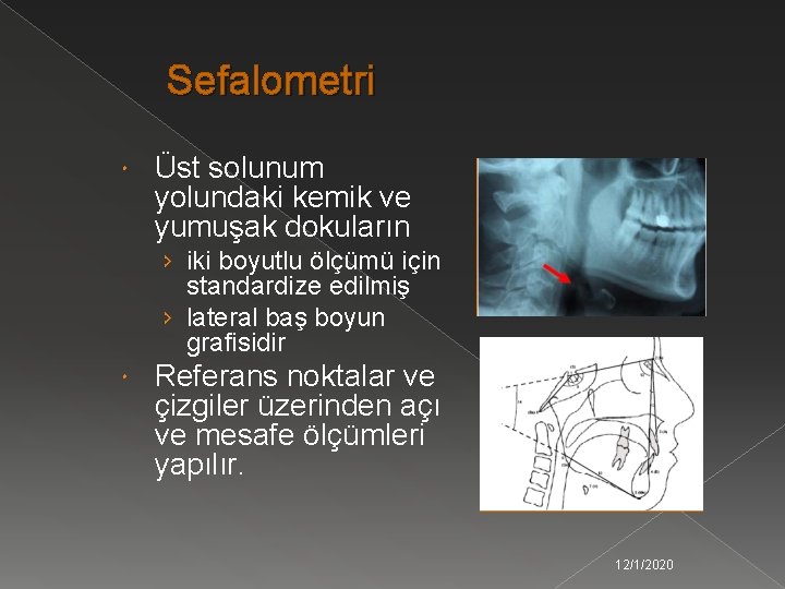 Sefalometri Üst solunum yolundaki kemik ve yumuşak dokuların › iki boyutlu ölçümü için standardize
