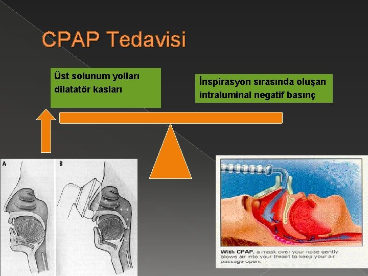 CPAP Tedavisi Üst solunum yolları dilatatör kasları İnspirasyon sırasında oluşan intraluminal negatif basınç 