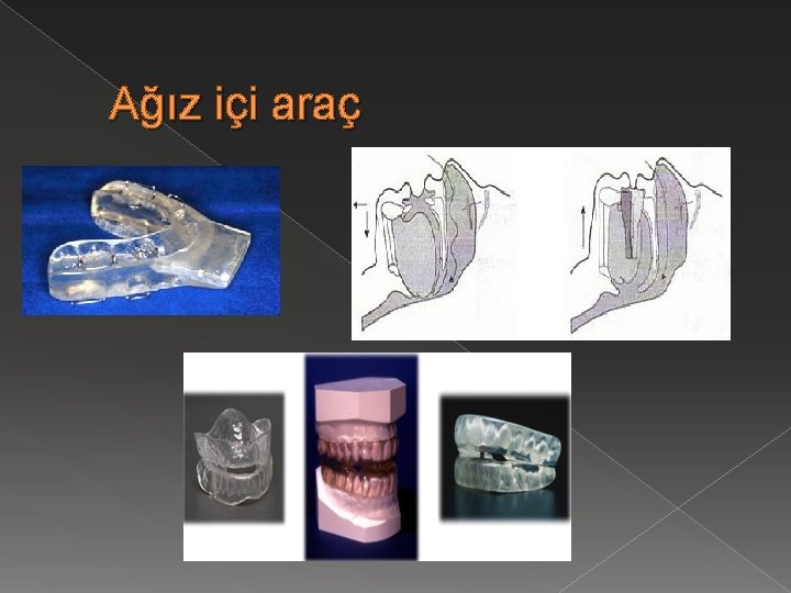 Ağız içi araç 