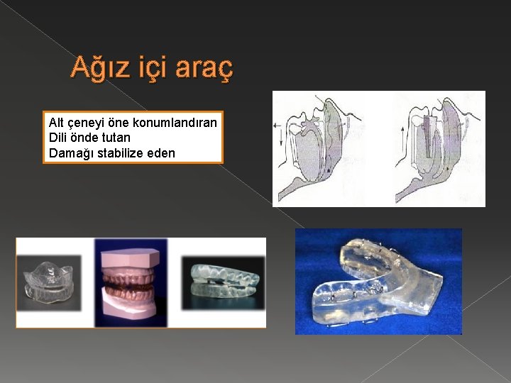 Ağız içi araç Alt çeneyi öne konumlandıran Dili önde tutan Damağı stabilize eden 