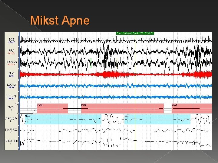 Mikst Apne 