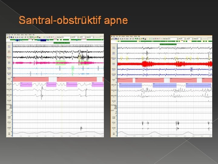 Santral-obstrüktif apne 