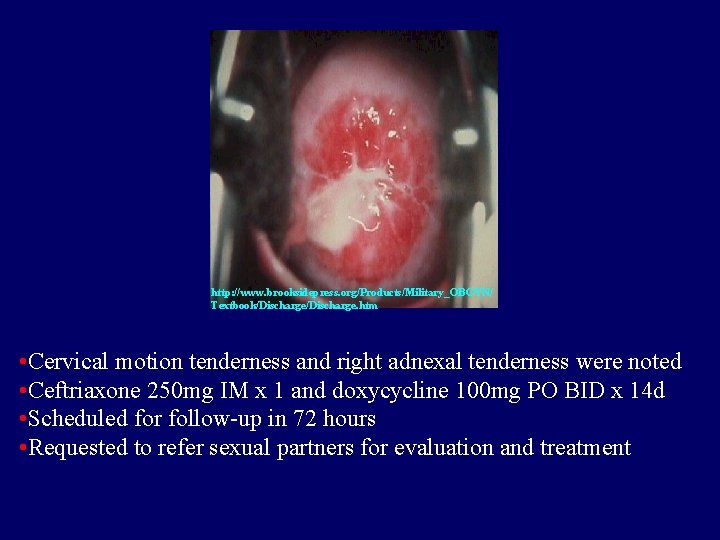 http: //www. brooksidepress. org/Products/Military_OBGYN/ Textbook/Discharge. htm • Cervical motion tenderness and right adnexal tenderness