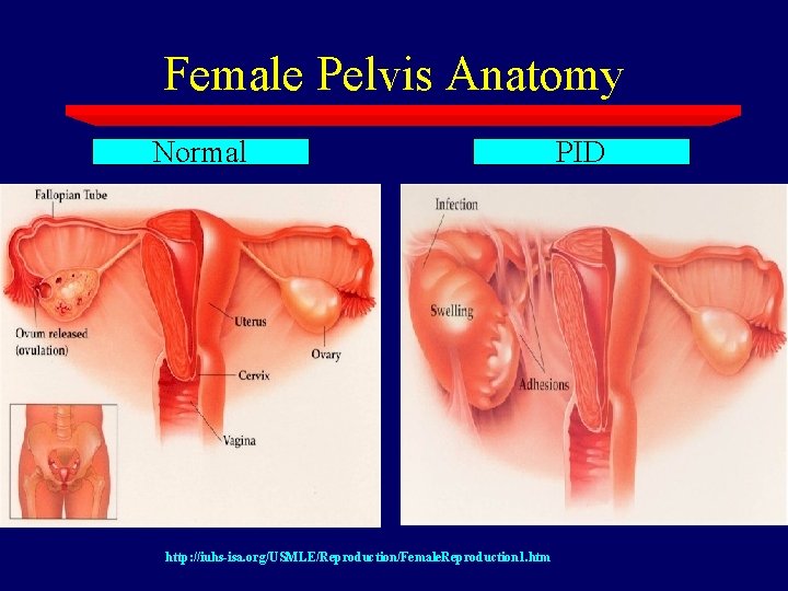 Female Pelvis Anatomy Normal http: //iuhs-isa. org/USMLE/Reproduction/Female. Reproduction 1. htm PID 