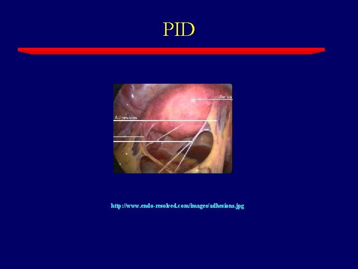 PID http: //www. endo-resolved. com/images/adhesions. jpg 