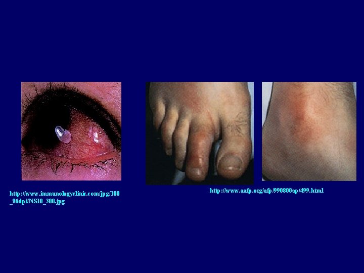 http: //www. immunologyclinic. com/jpg/300 _96 dpi/NS 10_300. jpg http: //www. aafp. org/afp/990800 ap/499. html