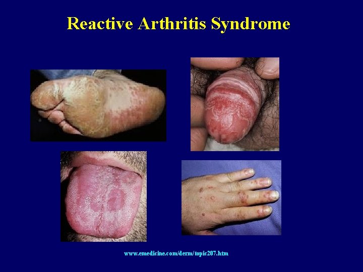 Reactive Arthritis Syndrome www. emedicine. com/derm/topic 207. htm 